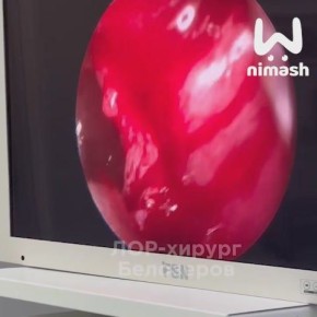 Нижегородские врачи прооперировали сыровара с грибковым поражением пазух носа